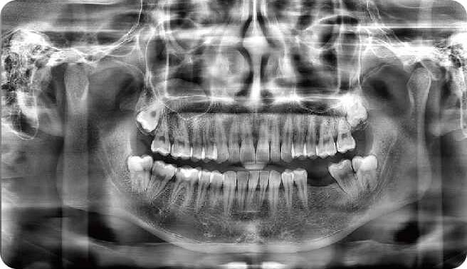 Wholesale Digital 3D OPG Panoramic X-Ray Dental CBCT Unit with Cephalometric Manufacturer and Supplier   JPS