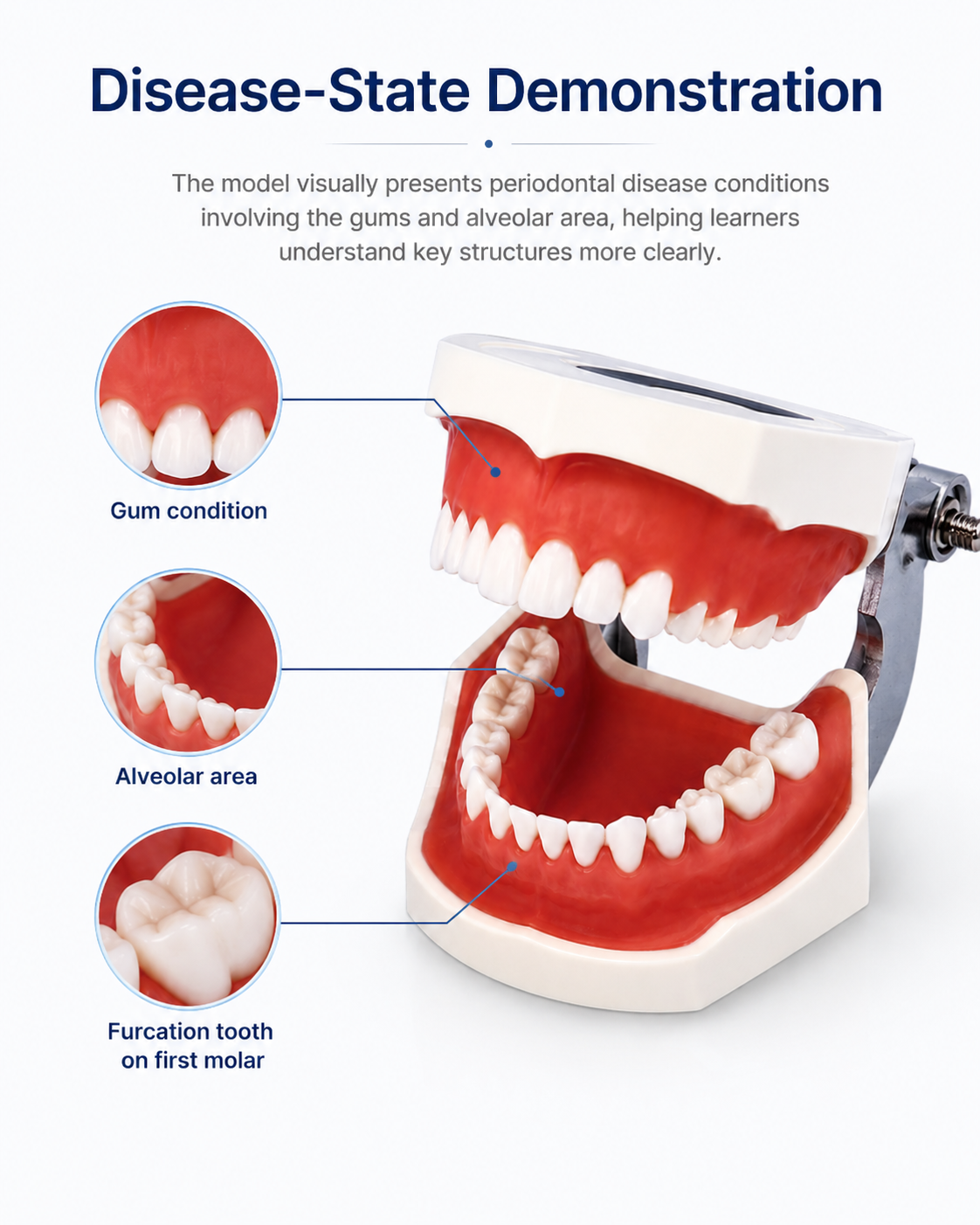 Periodontal Disease Model detail 2